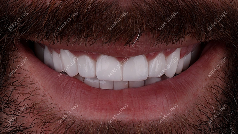 Full Smile Restoration